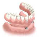 Perfect Smile implant supported overdenture